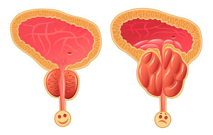 Normalna i upaljena prostata