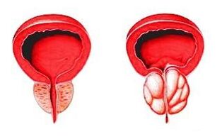 Prostata u normalnom stanju (lijevo) i upaljena prostatitisom (desno)